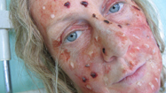 まだらの怪物の復活 (Return of The Speckled Monster)の写真